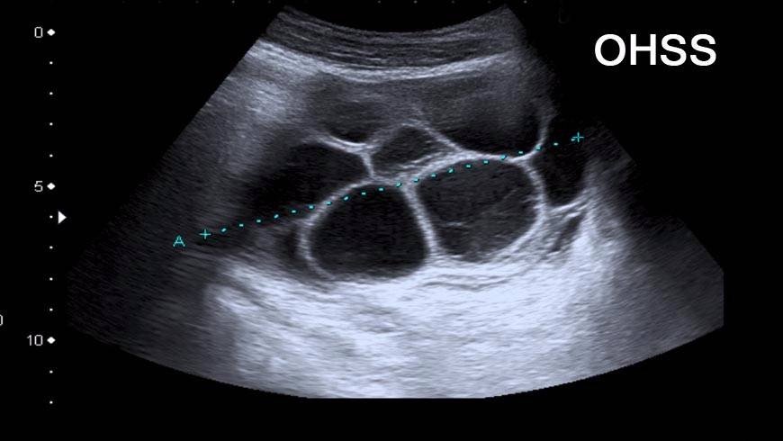 IVF рискове: 2.OHSS